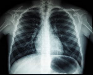 X-rays: Chest X-rays